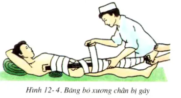 Giải sinh 8 bài 12: Thực hành Tập sơ cứu và băng bó cho người gãy xương